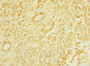 Immunohistochemistry of paraffin-embedded human pancreatic cancer using CAC10903 at dilution of 1:100