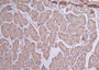 Immunohistochemistry of paraffin-embedded human pancreatic cancer using CAC10906 at dilution of 1:100