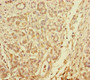 Immunohistochemistry of paraffin-embedded human pancreatic cancer using CAC10925 at dilution of 1:100