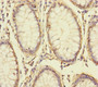Immunohistochemistry of paraffin-embedded human colon cancer using CAC10926 at dilution of 1:100