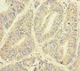 Immunohistochemistry of paraffin-embedded human colon cancer using CAC10927 at dilution of 1:100