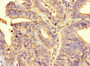 Immunohistochemistry of paraffin-embedded human endometrial cancer using CAC10930 at dilution of 1:100