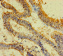 Immunohistochemistry of paraffin-embedded human endometrial cancer using CAC10931 at dilution of 1:100