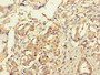 Immunohistochemistry of paraffin-embedded human pancreatic cancer using CAC10941 at dilution of 1:100