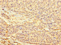 Immunohistochemistry of paraffin-embedded human ovarian cancer using CAC10943 at dilution of 1:100