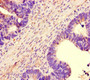Immunohistochemistry of paraffin-embedded human ovarian cancer using CAC10946 at dilution of 1:100