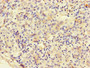 Immunohistochemistry of paraffin-embedded human lung cancer using CAC10954 at dilution of 1:100