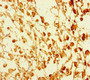 Immunohistochemistry of paraffin-embedded human melanoma using CAC10956 at dilution of 1:100