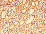 Immunohistochemistry of paraffin-embedded human gastric cancer using CAC10957 at dilution of 1:100