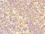 Immunohistochemistry of paraffin-embedded human cervical cancer using CAC10957 at dilution of 1:100