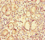 Immunohistochemistry of paraffin-embedded human gastric cancer using CAC10959 at dilution of 1:100