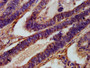 IHC image diluted at 1:1000 and staining in paraffin-embedded human colon cancer performed on a Leica BondTM system. After dewaxing and hydration, antigen retrieval was mediated by high pressure in a citrate buffer (pH 6.0). Section was blocked with 10% normal goat serum 30min at RT. Then primary antibody (1% BSA) was incubated at 4°C overnight. The primary is detected by a biotinylated secondary antibody and visualized using an HRP conjugated SP system.