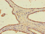 Immunohistochemistry of paraffin-embedded human prostate cancer using CAC10966 at dilution of 1:100