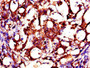 Immunohistochemistry of paraffin-embedded human gastric cancer using CAC10967 at dilution of 1:100