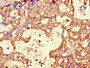 Immunohistochemistry of paraffin-embedded human gastric cancer using CAC10970 at dilution of 1:100