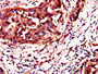 Immunohistochemistry of paraffin-embedded human bladder cancer using CAC10980 at dilution of 1:100