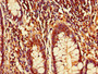 Immunohistochemistry of paraffin-embedded human colon cancer using CAC10990 at dilution of 1:100