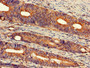 Immunohistochemistry of paraffin-embedded human colon cancer using CAC11051 at dilution of 1:100