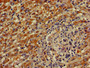 Immunohistochemistry of paraffin-embedded human liver cancer using CAC11054 at dilution of 1:100