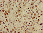 Immunohistochemistry of paraffin-embedded human glioma using CAC11056 at dilution of 1:100