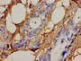 Immunohistochemistry analysis of human pancreatic cancer using CAC11059 at dilution of 1:100