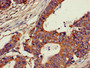 Immunohistochemistry of paraffin-embedded human colon cancer using CAC11062 at dilution of 1:100