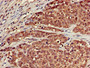 Immunohistochemistry of paraffin-embedded human ovarian cancer using CAC11066 at dilution of 1:100