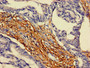 Immunohistochemistry of paraffin-embedded human colon cancer using CAC11095 at dilution of 1:100