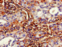 Immunohistochemistry of paraffin-embedded human lung cancer using CAC11101 at dilution of 1:100