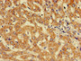 Immunohistochemistry of paraffin-embedded human liver cancer using CAC11103 at dilution of 1:100