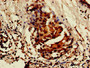 Immunohistochemistry of paraffin-embedded human breast cancer using CAC11118 at dilution of 1:100