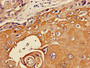 Immunohistochemistry of paraffin-embedded human ovarian cancer using CAC11125 at dilution of 1:100