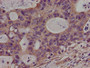 Immunohistochemistry of paraffin-embedded human colon cancer using CAC11132 at dilution of 1:100
