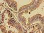 Immunohistochemistry of paraffin-embedded human endometrial cancer using CAC11134 at dilution of 1:100