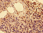 Immunohistochemistry of paraffin-embedded human glioma using CAC11137 at dilution of 1:100