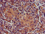 IHC image diluted at 1:400 and staining in paraffin-embedded human pancreatic tissue performed on a Leica BondTM system. After dewaxing and hydration, antigen retrieval was mediated by high pressure in a citrate buffer (pH 6.0). Section was blocked with 10% normal goat serum 30min at RT. Then primary antibody (1% BSA) was incubated at 4°C overnight. The primary is detected by a biotinylated secondary antibody and visualized using an HRP conjugated SP system.
