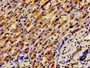 Immunohistochemistry of paraffin-embedded human liver cancer using CAC11181 at dilution of 1:100