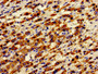 Immunohistochemistry of paraffin-embedded human liver cancer using CAC11186 at dilution of 1:100