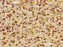 Immunohistochemistry of paraffin-embedded human glioma using CAC11195 at dilution of 1:100