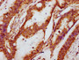 IHC image diluted at 1:100 and staining in paraffin-embedded human colon cancer performed on a Leica BondTM system. After dewaxing and hydration, antigen retrieval was mediated by high pressure in a citrate buffer (pH 6.0). Section was blocked with 10% normal goat serum 30min at RT. Then primary antibody (1% BSA) was incubated at 4°C overnight. The primary is detected by a biotinylated secondary antibody and visualized using an HRP conjugated SP system.