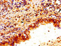 Immunohistochemistry of paraffin-embedded human lung cancer using CAC11201 at dilution of 1:100