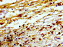 Immunohistochemistry of paraffin-embedded human melanoma using CAC11206 at dilution of 1:100