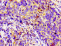 Immunohistochemistry of paraffin-embedded human pancreatic cancer using CAC11221 at dilution of 1:100