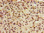 Immunohistochemistry of paraffin-embedded human glioma using CAC11225 at dilution of 1:100