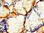 IHC image diluted at 1:300 and staining in paraffin-embedded human thyroid tissue performed on a Leica BondTM system. After dewaxing and hydration, antigen retrieval was mediated by high pressure in a citrate buffer (pH 6.0). Section was blocked with 10% normal goat serum 30min at RT. Then primary antibody (1% BSA) was incubated at 4°C overnight. The primary is detected by a biotinylated secondary antibody and visualized using an HRP conjugated SP system.