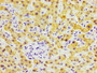 IHC image diluted at 1:300 and staining in paraffin-embedded human liver cancer performed on a Leica BondTM system. After dewaxing and hydration, antigen retrieval was mediated by high pressure in a citrate buffer (pH 6.0). Section was blocked with 10% normal goat serum 30min at RT. Then primary antibody (1% BSA) was incubated at 4°C overnight. The primary is detected by a biotinylated secondary antibody and visualized using an HRP conjugated SP system.