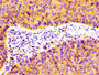 IHC image diluted at 1:100 and staining in paraffin-embedded human cervical cancer performed on a Leica BondTM system. After dewaxing and hydration, antigen retrieval was mediated by high pressure in a citrate buffer (pH 6.0). Section was blocked with 10% normal goat serum 30min at RT. Then primary antibody (1% BSA) was incubated at 4°C overnight. The primary is detected by a biotinylated secondary antibody and visualized using an HRP conjugated SP system.