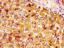 IHC image diluted at 1:400 and staining in paraffin-embedded human liver tissue performed on a Leica BondTM system. After dewaxing and hydration, antigen retrieval was mediated by high pressure in a citrate buffer (pH 6.0). Section was blocked with 10% normal goat serum 30min at RT. Then primary antibody (1% BSA) was incubated at 4°C overnight. The primary is detected by a biotinylated secondary antibody and visualized using an HRP conjugated SP system.