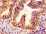 IHC image of CAC11249 diluted at 1:300 and staining in paraffin-embedded human endometrial cancer performed on a Leica BondTM system. After dewaxing and hydration, antigen retrieval was mediated by high pressure in a citrate buffer (pH 6.0). Section was blocked with 10% normal goat serum 30min at RT. Then primary antibody (1% BSA) was incubated at 4°C overnight. The primary is detected by a biotinylated secondary antibody and visualized using an HRP conjugated SP system.