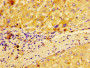 IHC image diluted at 1:100 and staining in paraffin-embedded human liver tissue performed on a Leica BondTM system. After dewaxing and hydration, antigen retrieval was mediated by high pressure in a citrate buffer (pH 6.0). Section was blocked with 10% normal goat serum 30min at RT. Then primary antibody (1% BSA) was incubated at 4°C overnight. The primary is detected by a biotinylated secondary antibody and visualized using an HRP conjugated SP system.